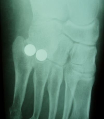 Orthosphere Tarso-Metatarsal Implants (Implant 389)